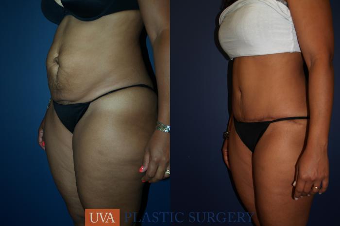 Tummy Tuck (Abdominoplasty) Case 68 Before & After View #4 | Richmond, Charlottesville & Roanoke, VA | University of Virginia Plastic Surgery