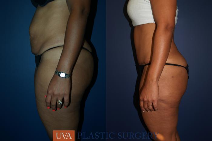 Tummy Tuck (Abdominoplasty) Case 68 Before & After View #5 | Richmond, Charlottesville & Roanoke, VA | University of Virginia Plastic Surgery