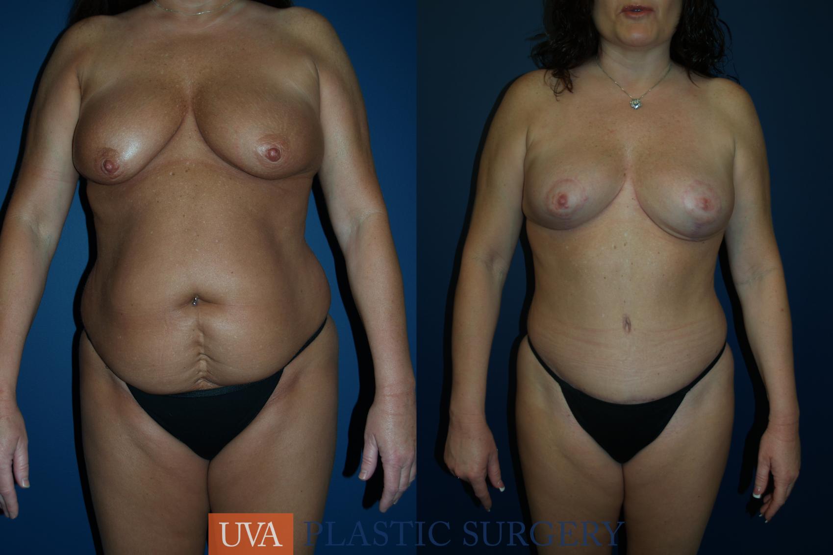 Tummy Tuck (Abdominoplasty) Case 82 Before & After View #1 | Richmond, Charlottesville & Roanoke, VA | University of Virginia Plastic Surgery