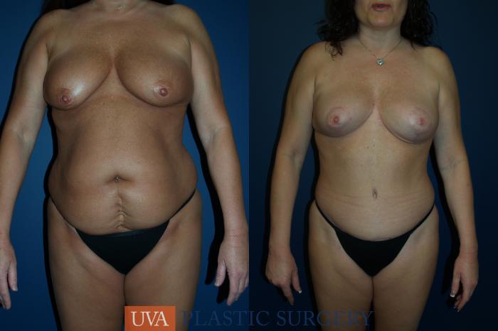 Tummy Tuck (Abdominoplasty) Case 82 Before & After View #1 | Richmond, Charlottesville & Roanoke, VA | University of Virginia Plastic Surgery