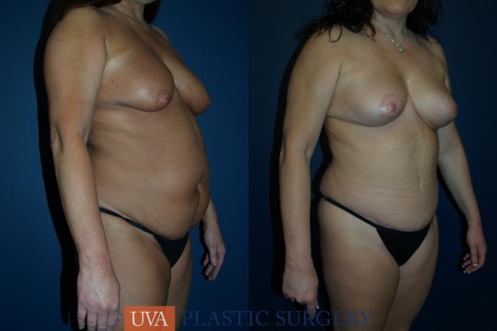 Tummy Tuck (Abdominoplasty) Case 82 Before & After View #3 | Richmond, Charlottesville & Roanoke, VA | University of Virginia Plastic Surgery