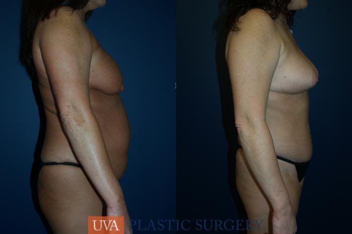 Tummy Tuck (Abdominoplasty) Case 82 Before & After View #4 | Richmond, Charlottesville & Roanoke, VA | University of Virginia Plastic Surgery