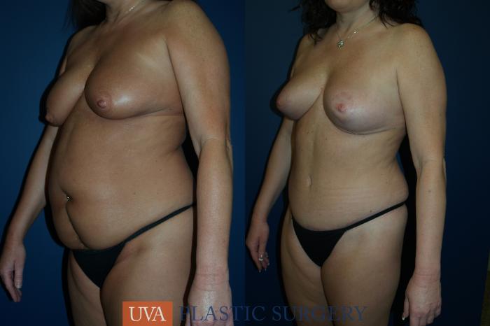 Tummy Tuck (Abdominoplasty) Case 82 Before & After View #5 | Richmond, Charlottesville & Roanoke, VA | University of Virginia Plastic Surgery
