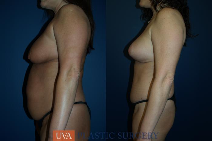 Tummy Tuck (Abdominoplasty) Case 82 Before & After View #6 | Richmond, Charlottesville & Roanoke, VA | University of Virginia Plastic Surgery
